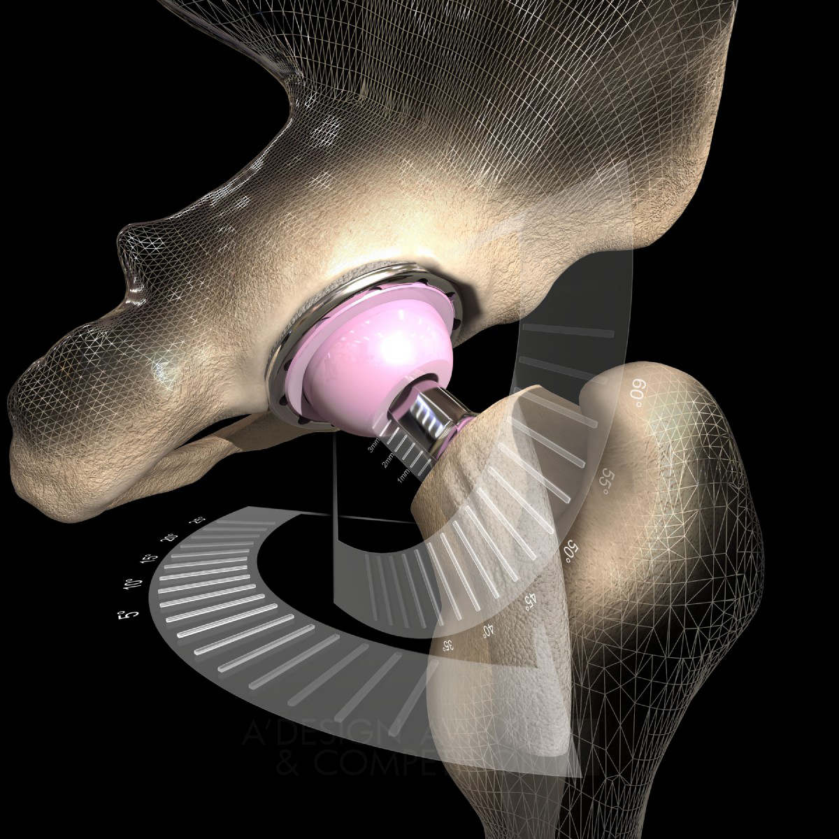 The Optimized Positioning System Personalized Hip Replacement Technology