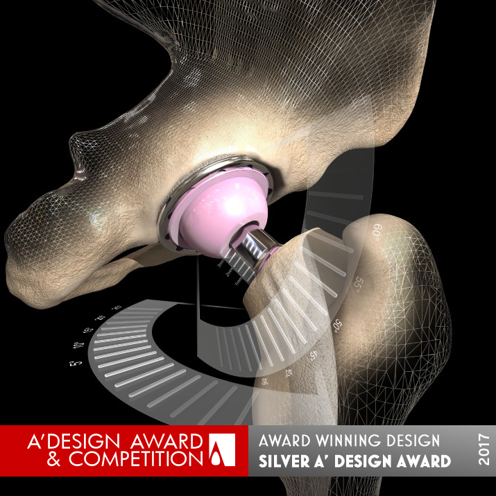 OPS™ Personalized Hip Replacement Technology by Optimized Ortho and Corin Group Silver Medical Devices and Medical Equipment Design Award Winner 2017 