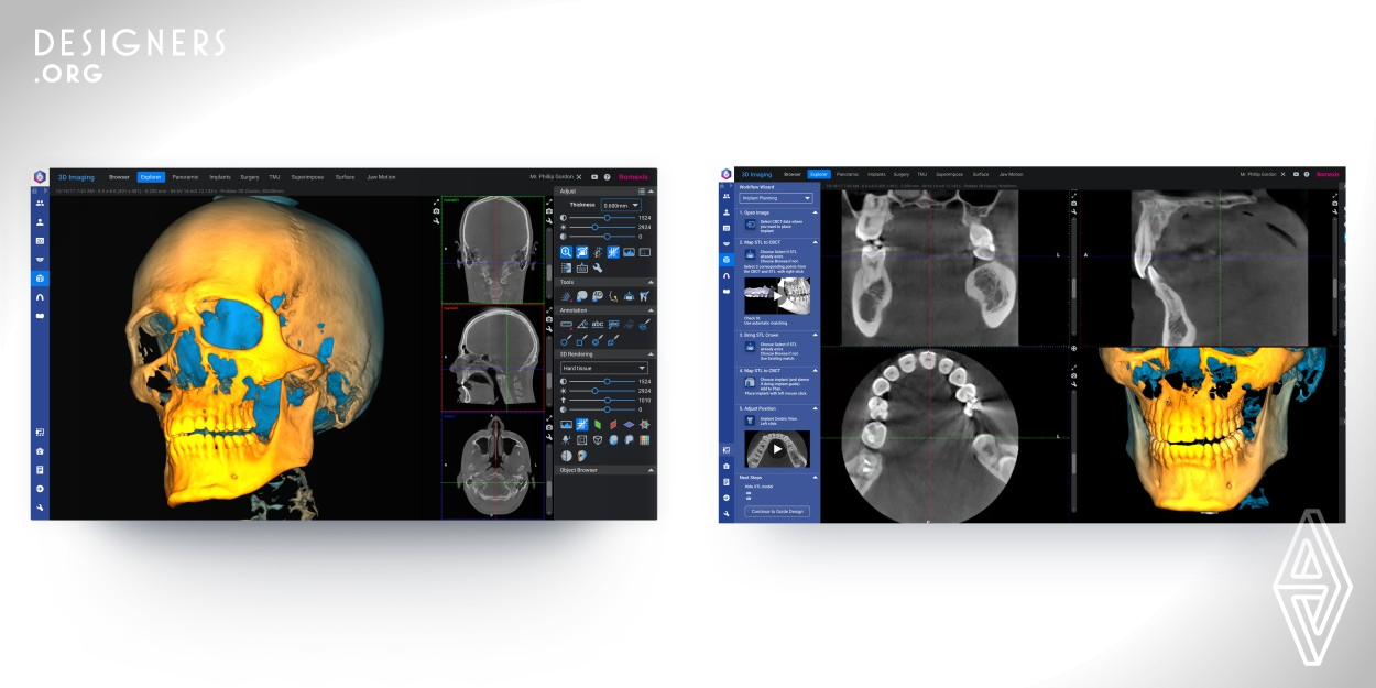 All-in-one ideology has always been at the core of Planmeca Romexis. Dental professionals handle many types of dental images every day. Planmeca Romexis allows working with this data simultaneously and in a single software. Planmeca Romexis 6 takes this concept even further with a completely rethought user interface, which simplifies a multitude of functionalities into an accessible and customisable system. Designed specifically with the user in mind, Planmeca Romexis 6 does not determine the workflow for the user, but allows the user to tailor it for themselves. 