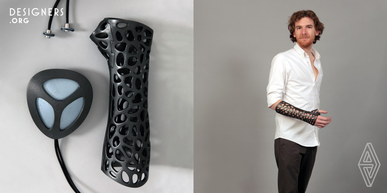 The goal of this project is to improve the overall healing experience for broken or fractured limbs by focusing on the patient’s comfort and healing time. Osteoid cast offers a new way of tackling these problems by introducing new technologies which enables us to make custom fitted, durable 3D printed medical casts that doesn't itch or smell. The end products are slimmer, lighter, doesn't affect from water and environmentally friendly. This cast can also be combined with, a low intensity pulsed ultrasound (LIPUS) bone stimulator resulting in faster recovery.