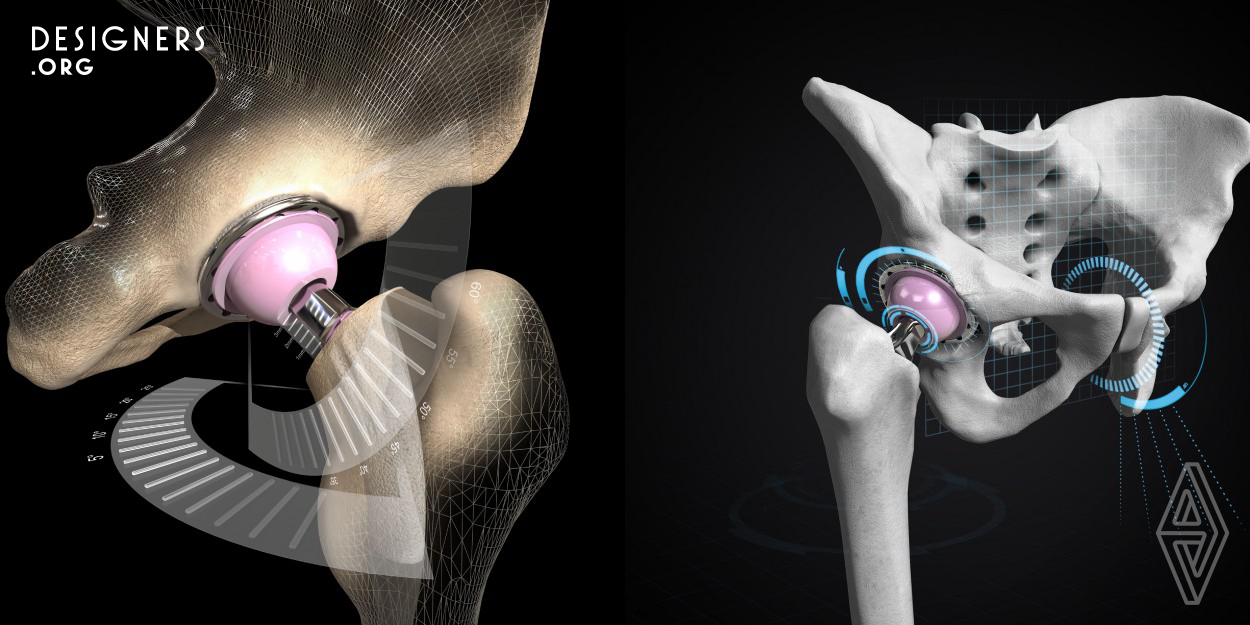 The OPS™ technology platform has recently been developed by incorporating the latest in 3D imaging technology in combination with patented kinematic simulation software derived from the aerospace and automotive industries. These pre-operative analytics provide the critical dynamic inputs required to understand each patient's movement profile before their operation. This information allows orthopaedic surgeons to better tailor total hip replacement procedures for each patient.