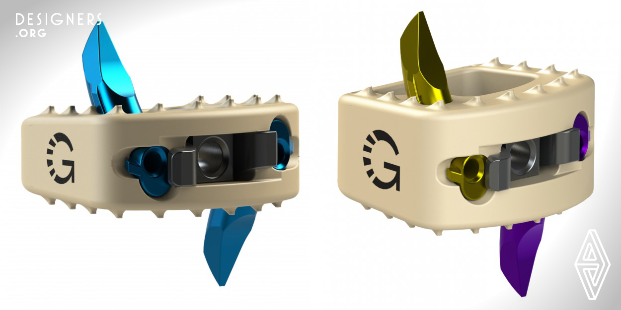 The AIS-C Stand-Alone System is a first of its kind, non-screw based, zero-profile, direct-anterior stand-alone interbody system for the cervical spine designed to provide the greatest ease of use to the surgeon at every step of the procedure. The direct anterior approach allows for a smaller, mid-line incision. Quick, simple, non-impacting anchor insertion does not require any additional instrumentation, and the zero-step locking mechanism provides visual confirmation of engagement, but allows for anchor removal when desired.