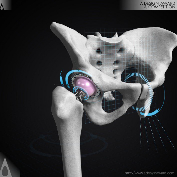 OPS™ - The Optimized Positioning System Personalized Hip Replacement Technology