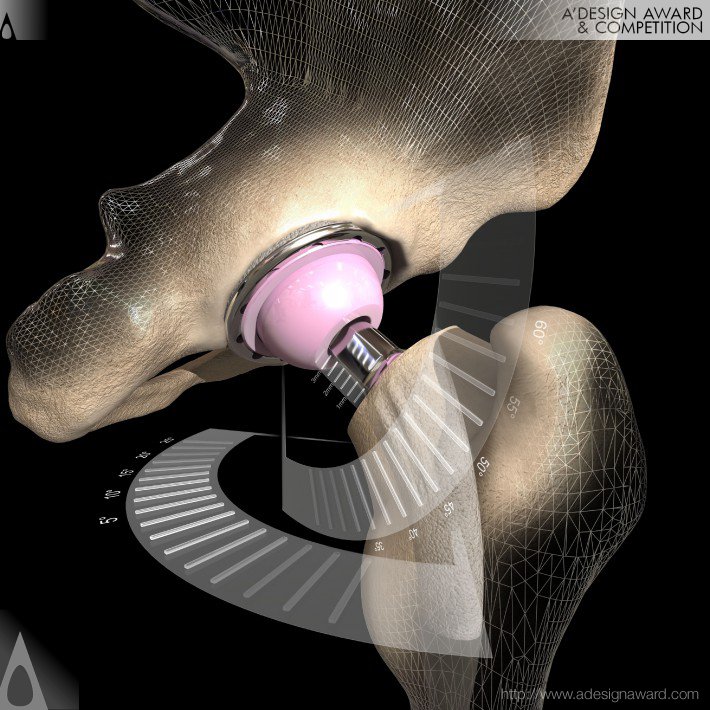 The Optimized Positioning System Personalized Hip Replacement Technology by OPS™